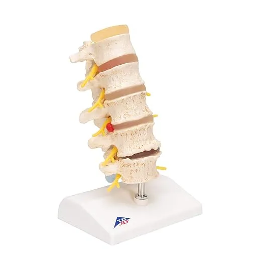 3B Scientific A795 Stages of prolapsed disc degeneration of vertebrae - 3B Smart Anatomy